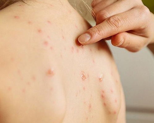 Điều Trị Mụn Lưng Tại Sen Beauty